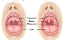 Чем убить стрептококк в горле